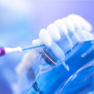 Phục hình Implant